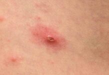 La Generalitat confirma nueve casos de viruela del mono en Cataluña La Generalitat confirma nueve casos del viruela del mono en Cataluña