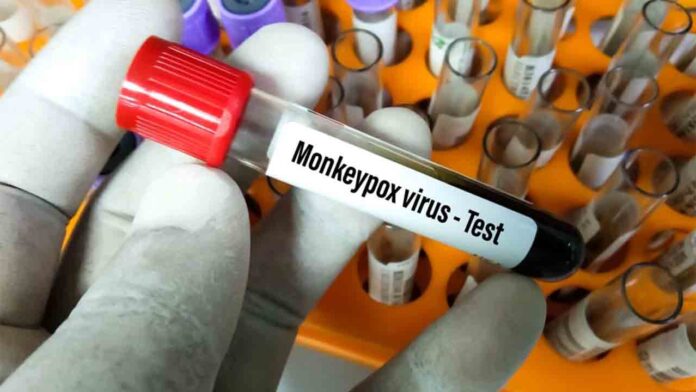 Sanidad eleva a 186 los casos detectados de viruela del mono en España