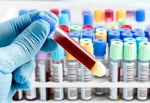 Impulso al primer test sanguíneo con valor pronóstico para el Alzheimer Impulso al primer test sanguíneo con valor pronóstico para el Alzheimer